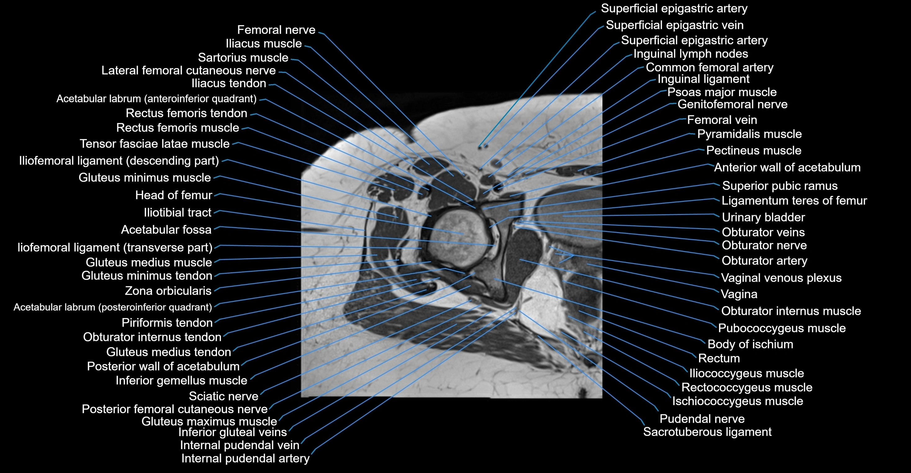 MRI hip axial cross sectional anatomy 3T 3D  radiology  anatomy image-img-00001-00039.webp